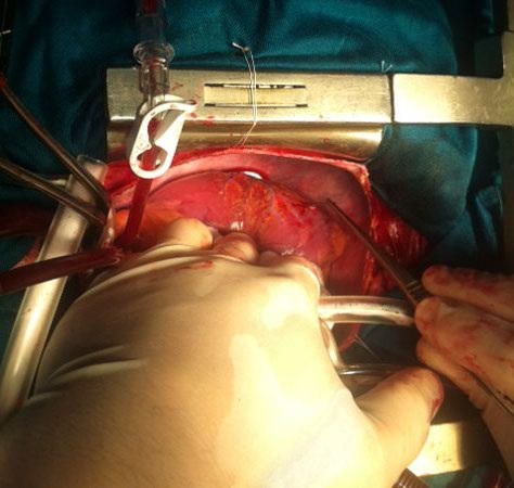 Hy hữu, kim khâu đâm thấu tim bệnh nhân - 1 Chiếc kim khâu đâm thủng lồng ngực, chui tọt vào thất trái tim của bệnh nhân. Ảnh: BS cung cấp