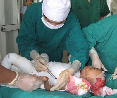 Nhiều trẻ nhỏ bị bỏng sâu vì không được cởi ngay quần áo ngấm nước nóng - 1 Tắm nước nóng, bị bỏng nặng