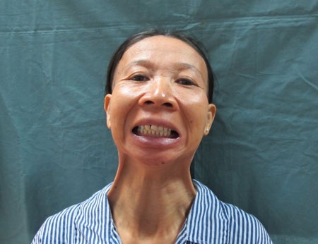 “Giải cứu” hàm răng bị dính chặt suốt 30 năm - 1 Hàm răng bệnh nhân bị khít chặt suốt 30 năm. Ảnh: Song Ngọc