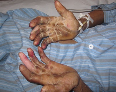 Tổn thương hoại tử chân, tay của bệnh nhân mắc liên cầu lợn thể