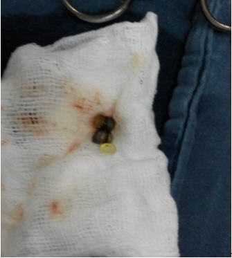 Chơi vương miện, bé 14 tháng tuổi suýt thiệt mạng - 1 Dị vật là 4 hạt kim loại được lấy ra từ ruột của bé. Ảnh: Bs cung cấp.