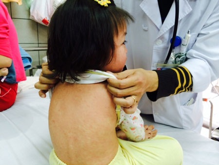 Thêm 4 ca tử vong vì biến chứng bệnh sởi