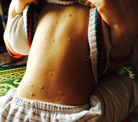 Vắc xin thủy đậu: Đã nhập khẩu về nhưng còn phải chờ! - 1 Nhiều trẻ bị thủy đậu vì thiếu vắc xin tiêm phòng. Ảnh: Tú Anh