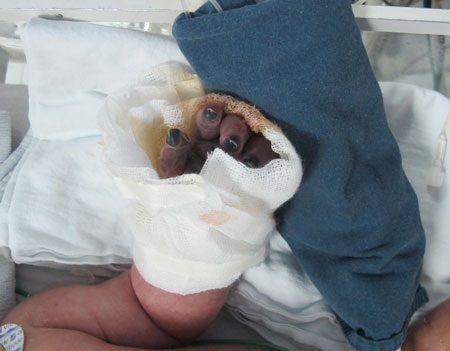 Em bé đã không qua khỏi vì tình trạng nhiễm trùng sơ sinh quá nặng nề. Ảnh: H.Hải