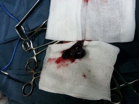 Bé 6 tháng tuổi phải cắt bỏ buồng trứng vì thoát vị bẹn - 1