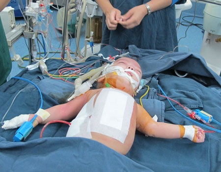 Đây là cặp song sinh dính liền thứ 3 được phẫu thuật tách rời thành công tại BV Nhi trung ương.