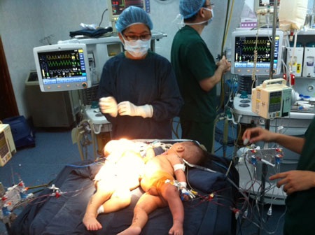 Hai bé được nuôi dưỡng 4 tháng, nặng 13,5kg/2 bé thì được tiến hành phẫu thuật tách rời.