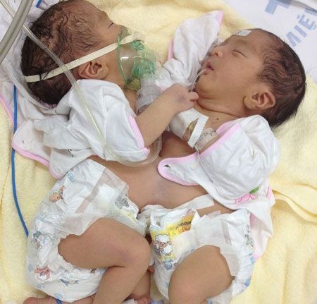 Cặp song sinh thời điểm mới nhập viện.