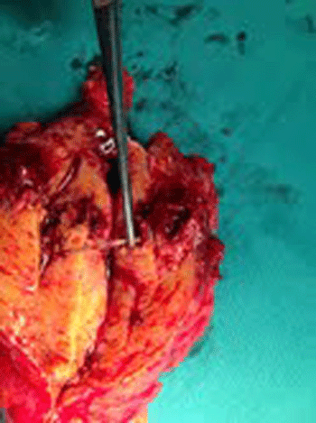 Hình ảnh bác sĩ gắp chiếc tăm tre đâm vào bụng bệnh nhân. Ảnh: BS cung cấp.