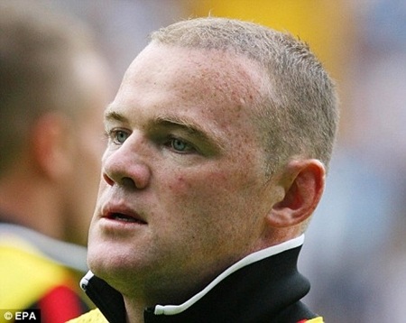 Rooney gặp phải tác dụng phụ của việc cấy tóc - 1 Rooney gặp phải tác dụng phụ của việc cấy tóc - 1