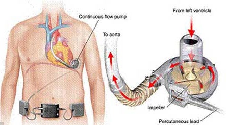 Kỳ lạ, thiếu nữ sống nhờ trái tim để trong túi xách - 1 Sơ đồ vận hành trái tim nhân tạo của Kyah