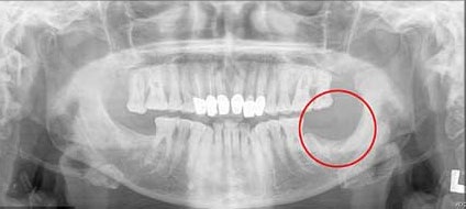 Bác sĩ đã phải cắt bỏ cả 1 phần xương hàm của bà Musa để giúp Bà hết đau nhưng cũng không hiệu quả