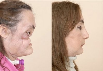 Gặp người phụ nữ đầu tiên được ghép mặt ở Mỹ - 3 Gặp người phụ nữ đầu tiên được ghép mặt ở Mỹ - 3