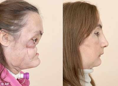 Ghép mặt người chết cho người sống - 1 Ghép mặt người chết cho người sống - 1