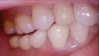 Quy trình cấy ghép implant - 3 Quy trình cấy ghép implant - 3