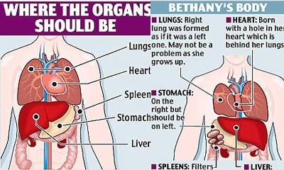 Sống khỏe với 5 lá lách và 1 lá gan hỏng... - 1 Sống khỏe với 5 lá lách và 1 lá gan hỏng... - 1