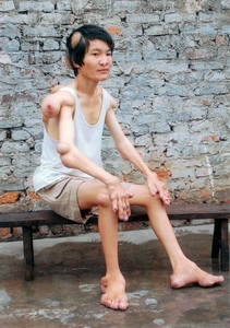 Quà Nhân ái đến với chàng trai gánh nhiều khối u - 1