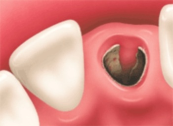 Nhổ răng kết hợp cấy ghép Implant trong 1 lần phẫu thuật - 1 Nhổ răng kết hợp cấy ghép Implant trong 1 lần phẫu thuật - 1