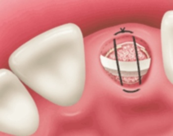 Nhổ răng kết hợp cấy ghép Implant trong 1 lần phẫu thuật - 2 Nhổ răng kết hợp cấy ghép Implant trong 1 lần phẫu thuật - 2
