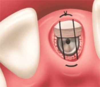 Nhổ răng kết hợp cấy ghép Implant trong 1 lần phẫu thuật - 3 Nhổ răng kết hợp cấy ghép Implant trong 1 lần phẫu thuật - 3