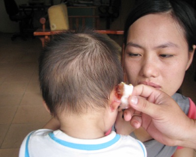 Bé trai 22 tháng tuổi bị sứt tai ở trường mầm non - 1