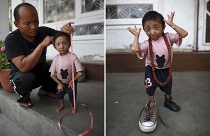 17 tuổi cân nặng 4,5 kg - 5