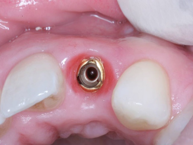 Phục hình Implant trong trường hợp mất răng riêng lẻ - 1