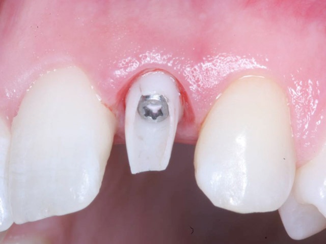 Phục hình Implant trong trường hợp mất răng riêng lẻ - 2