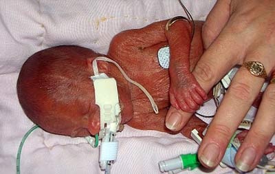 Sống khỏe mạnh dù chào đời sớm hơn 4 tháng - 2