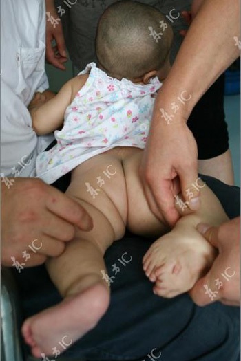 Bé gái chào đời với 3 bàn chân - 2 Bé gái chào đời với 3 bàn chân - 2