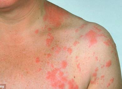 Vitamin C - thuốc mới chữa bệnh zona? - 1 Vitamin C - thuốc mới chữa bệnh zona? - 1