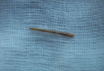 Một vụ hóc xương cá vô cùng hy hữu - 1