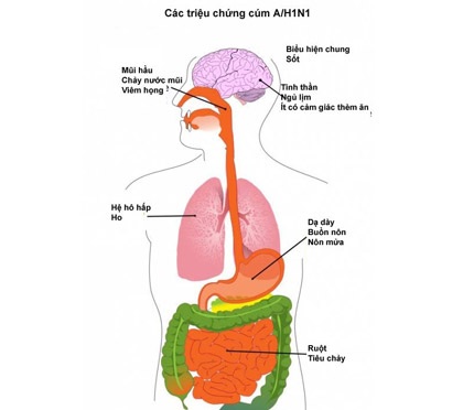 Những biểu hiện điển hình của cúm A/H1N1 - 1