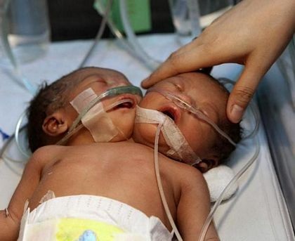 Thêm một trường hợp trẻ hai đầu ở Philippines - 7