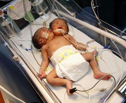 Thêm một trường hợp trẻ hai đầu ở Philippines - 6