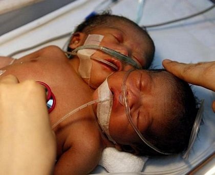 Thêm một trường hợp trẻ hai đầu ở Philippines - 5