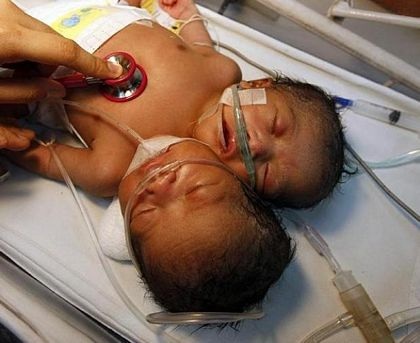 Thêm một trường hợp trẻ hai đầu ở Philippines - 4