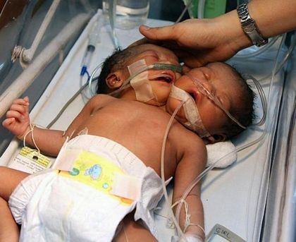 Thêm một trường hợp trẻ hai đầu ở Philippines - 3