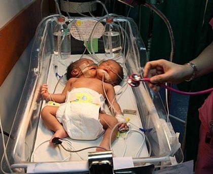 Thêm một trường hợp trẻ hai đầu ở Philippines - 2