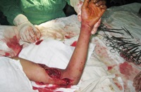 Bị máy cắt đập lúa cuốn đứt lìa cánh tay - 1