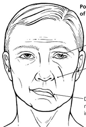 Đề phòng chứng “méo miệng” khi sang thu - 1