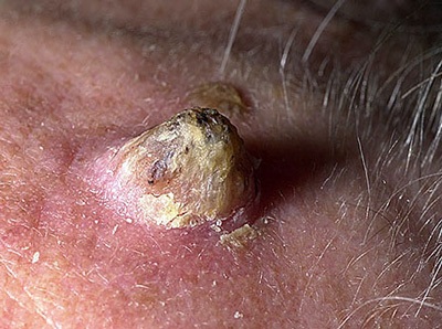 Những dấu hiệu của ung thư da - 3