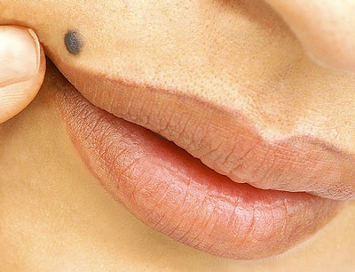 Những dấu hiệu của ung thư da - 4