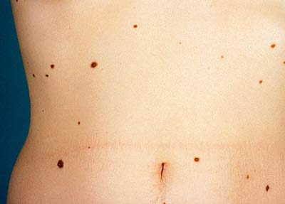 Những dấu hiệu của ung thư da - 5