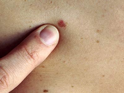 Những dấu hiệu của ung thư da - 6