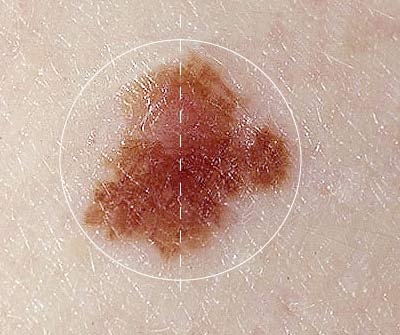 Những dấu hiệu của ung thư da - 7