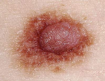 Những dấu hiệu của ung thư da - 8