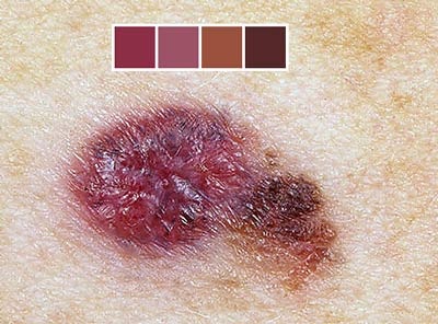 Những dấu hiệu của ung thư da - 9