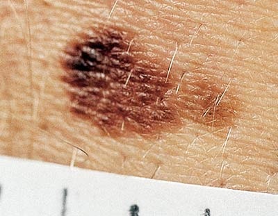 Những dấu hiệu của ung thư da - 10