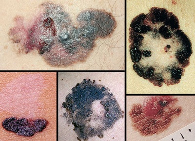 Những dấu hiệu của ung thư da - 15